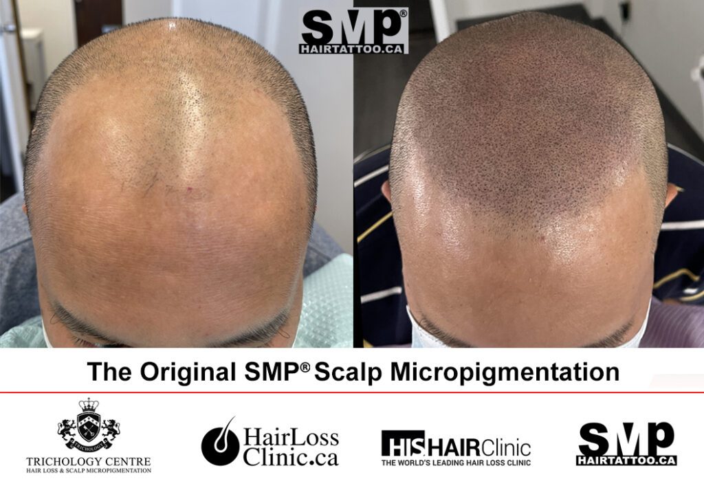 Scalp Micropigmentation