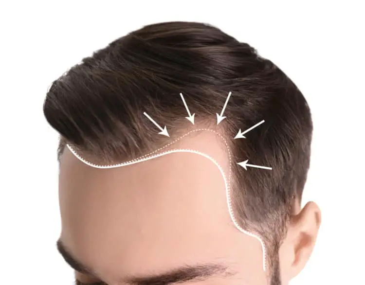 Advantages of hair transplant costs