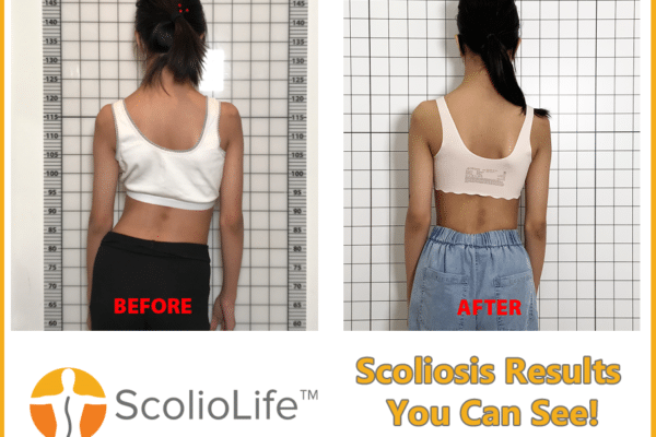 Scoliosis Surgery Singapore